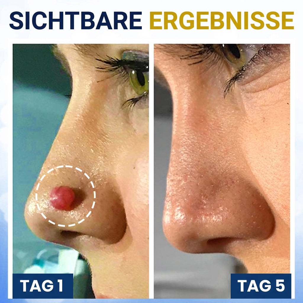 ✨ Schmerzfreie Entfernung für zu Hause | AEXZR® Stielwarzen Kryo-Behandlungsspray