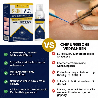 ✨ Schmerzfreie Entfernung für zu Hause | AEXZR® Stielwarzen Kryo-Behandlungsspray