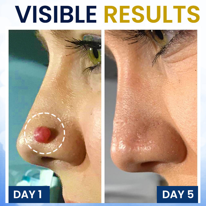 ❄️ Fast-Acting Cryo Formula! | ✨ Freeze Blemishes Instantly! | AEXZR® Skin Tag Cryo Treatment Spray