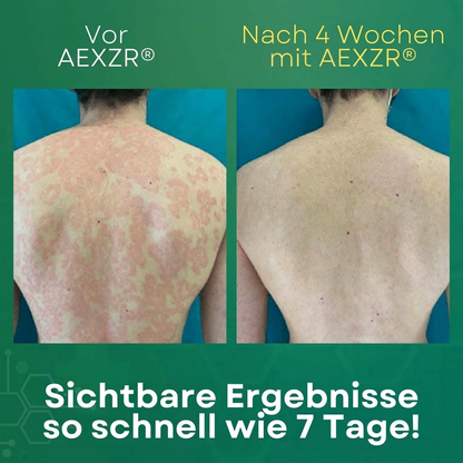 🏆 Von Dermatologen Empfohlen: Psoriasis-Creme zur Sofort-Linderung | Steroidfreie Formel für glatte & gesunde Haut ✨AEXZR® Psoriasis-Creme