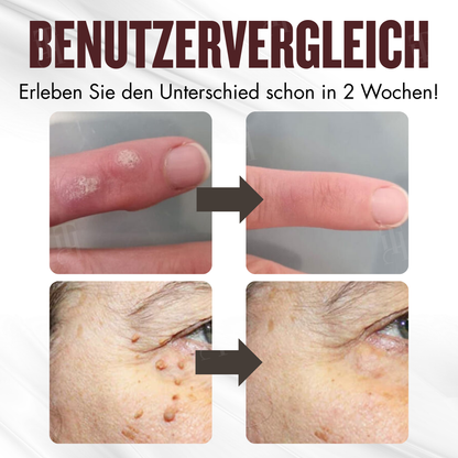 🏆Offizieller Store | 🛡️ Schluss mit brennenden Säuren! Entfernen Sie Hautmakel sanft & sicher RZXEA™ All-in-1 Ceramide Hautcreme